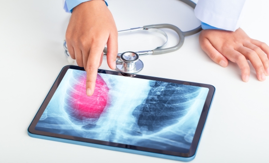 Lung Cancer Screening Benefits and Guidelines