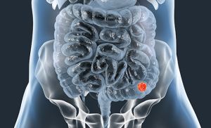 Education and Messaging Needed to Improve Outcomes for Young Colorectal Cancer Patients